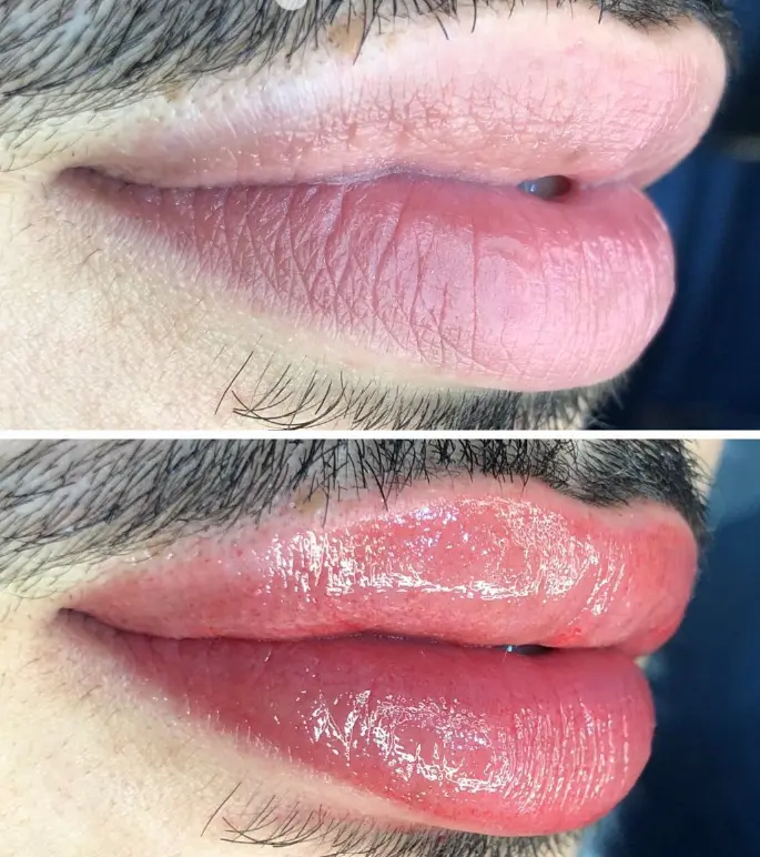 Revitalização Labial